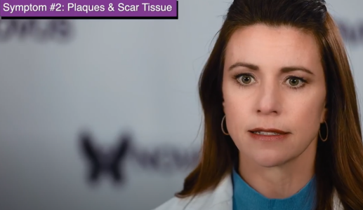Stephanie Wolff talks about Plaques & Scar Tissue as a symptom of Peyronie’s Disease