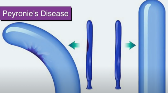 Erectile Dysfunction illustration